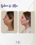 Deep plane facelift before and after results at Michel Salameh Clinic, visible facial lift
