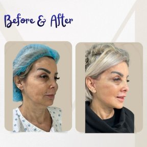 Before and after deep plane facelift results – visible facial rejuvenation and lifted contours