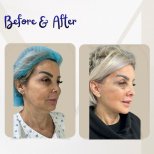 Before and after deep plane facelift results – visible facial rejuvenation and lifted contours