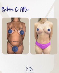 Mommy makeover before and after results at Michel Salameh Clinic – body contour improvement