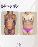 Mommy makeover before and after results at Michel Salameh Clinic – body contour improvement