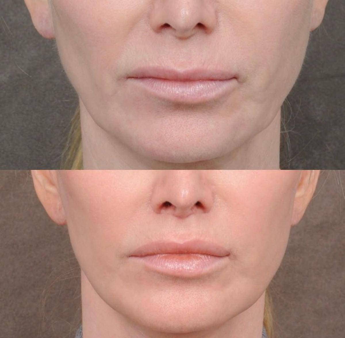 نتائج قبل وبعد رفع الشفاه في Dr. Alexandro Aguilera - Plastic Surgery، تحديد الشفاه المحسن