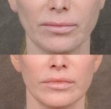 Результати до і після lip lift у Dr. Alexandro Aguilera - Plastic Surgery, покращений контур губ