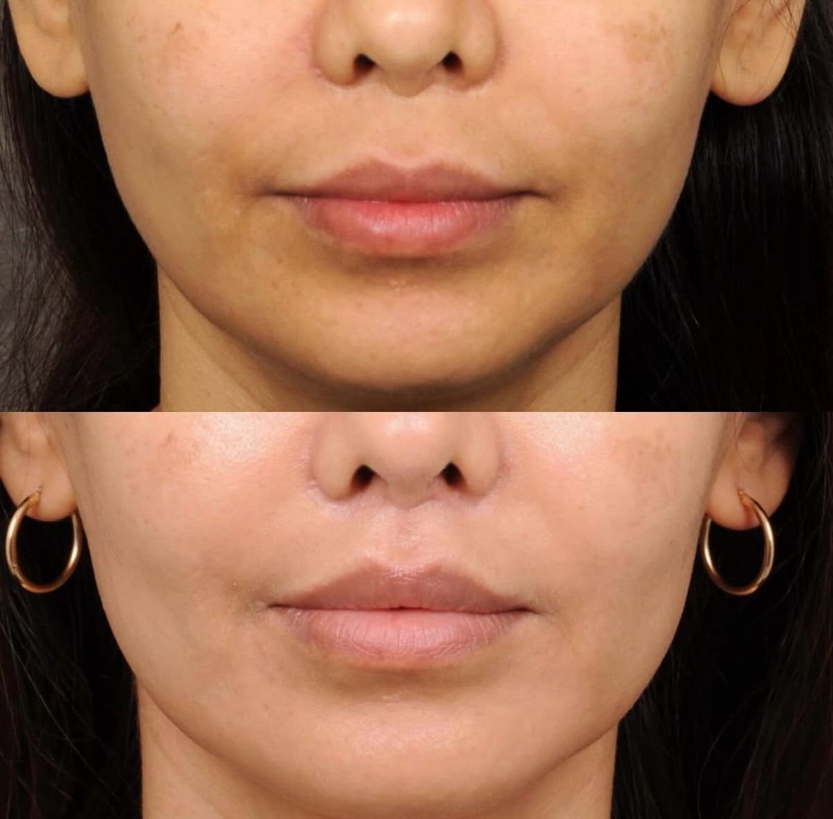 Resultados antes y después de lip lift en Dr. Alexandro Aguilera - Plastic Surgery, contorno mejorado