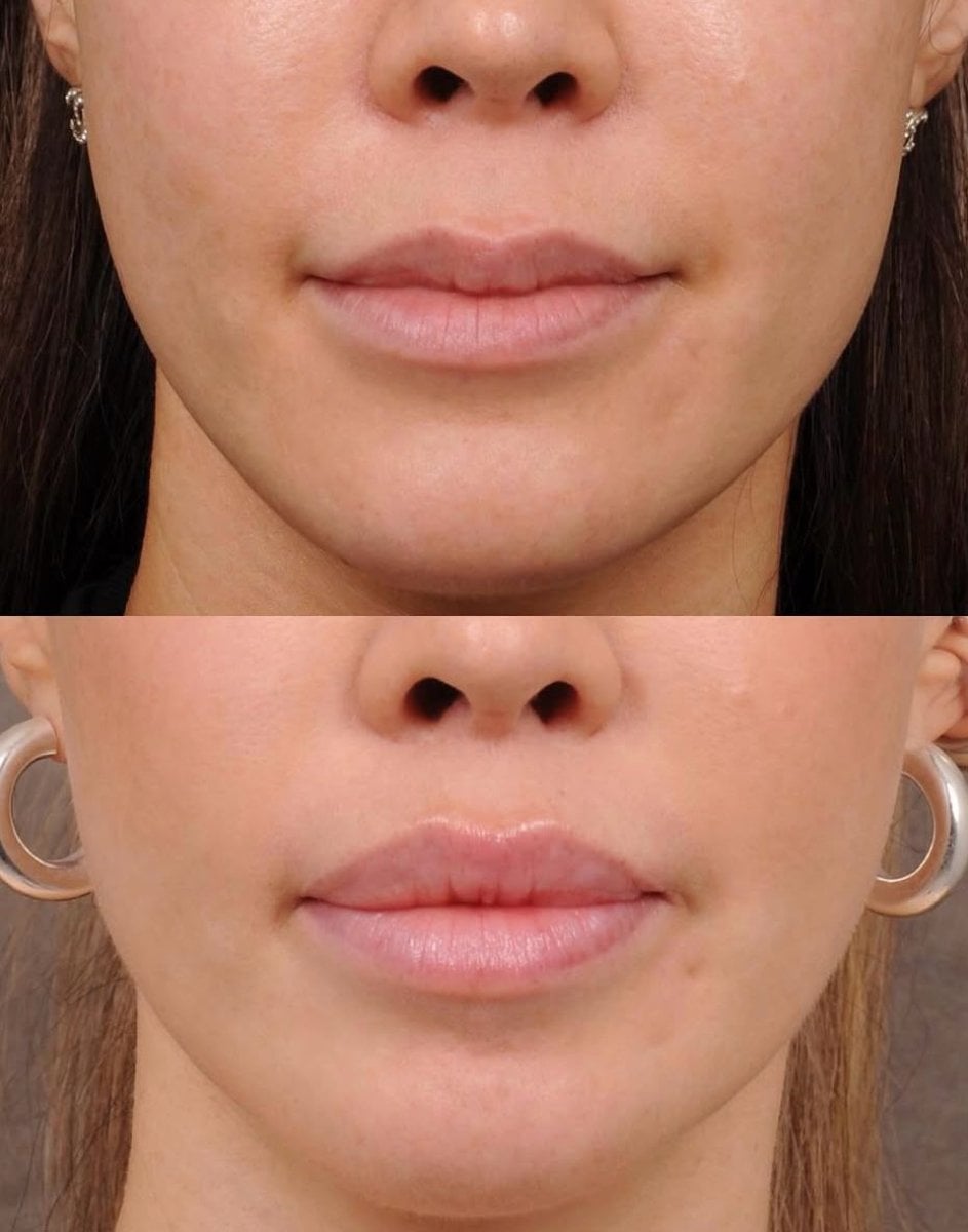 نتائج قبل وبعد رفع الشفاه في Dr. Alexandro Aguilera - Plastic Surgery، تحسين شكل الشفاه