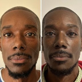 Vorher-nachher-Ergebnis der Blepharoplastik bei Dr. Safa Manav Clinic, Lidkorrektur für Männer