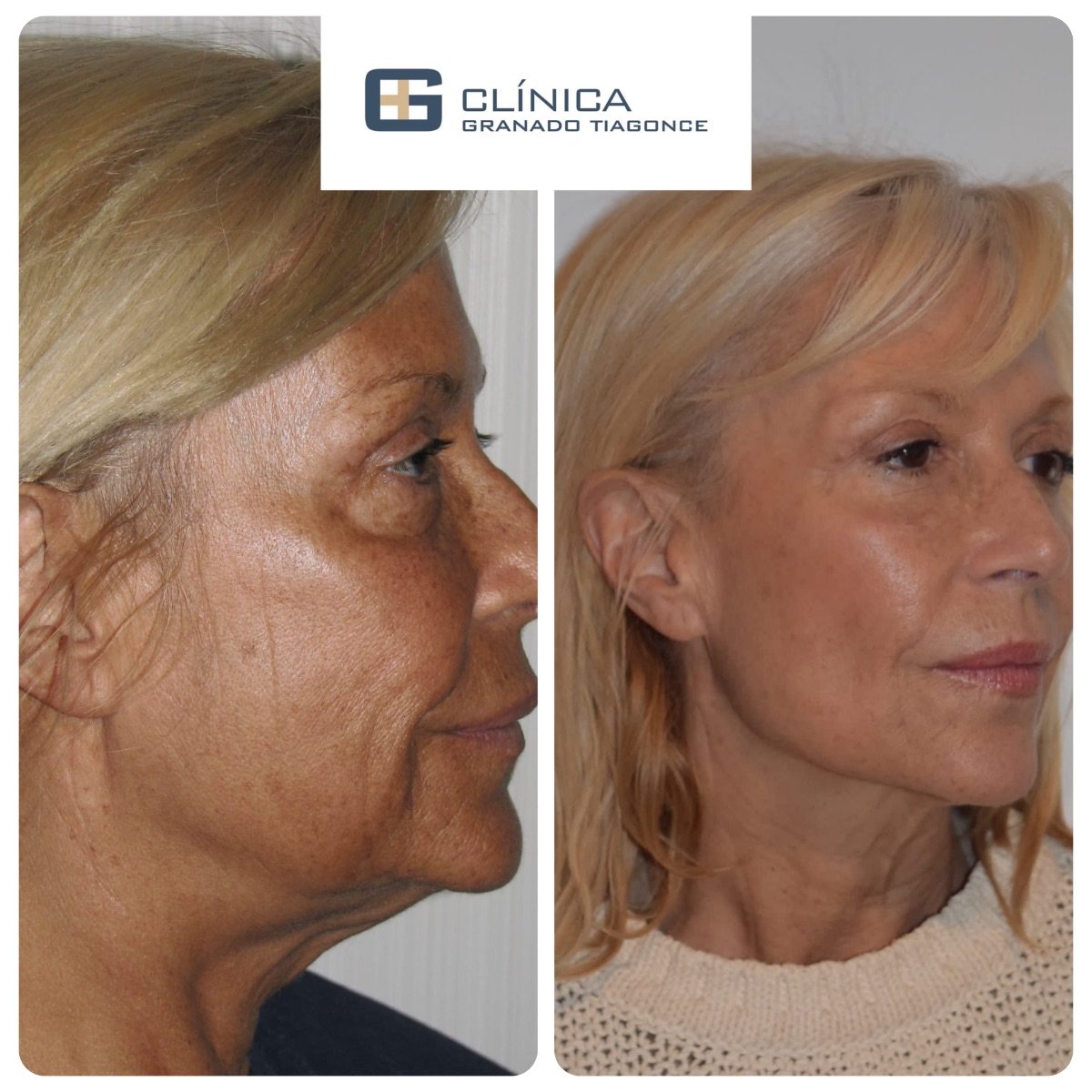 Resultados antes y después de Morpheus8 en Clinica Granado Tiagonce, rejuvenecimiento facial
