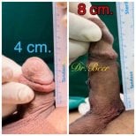 نتائج تكبير القضيب قبل وبعد في Eternity Clinic Phuket By Dr.Beer، زيادة الطول