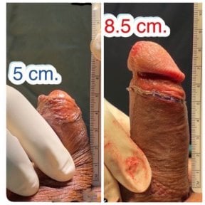 نتائج تكبير القضيب قبل وبعد في Eternity Clinic Phuket By Dr.Beer، زيادة الطول