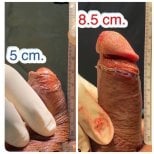 نتائج تكبير القضيب قبل وبعد في Eternity Clinic Phuket By Dr.Beer، زيادة الطول