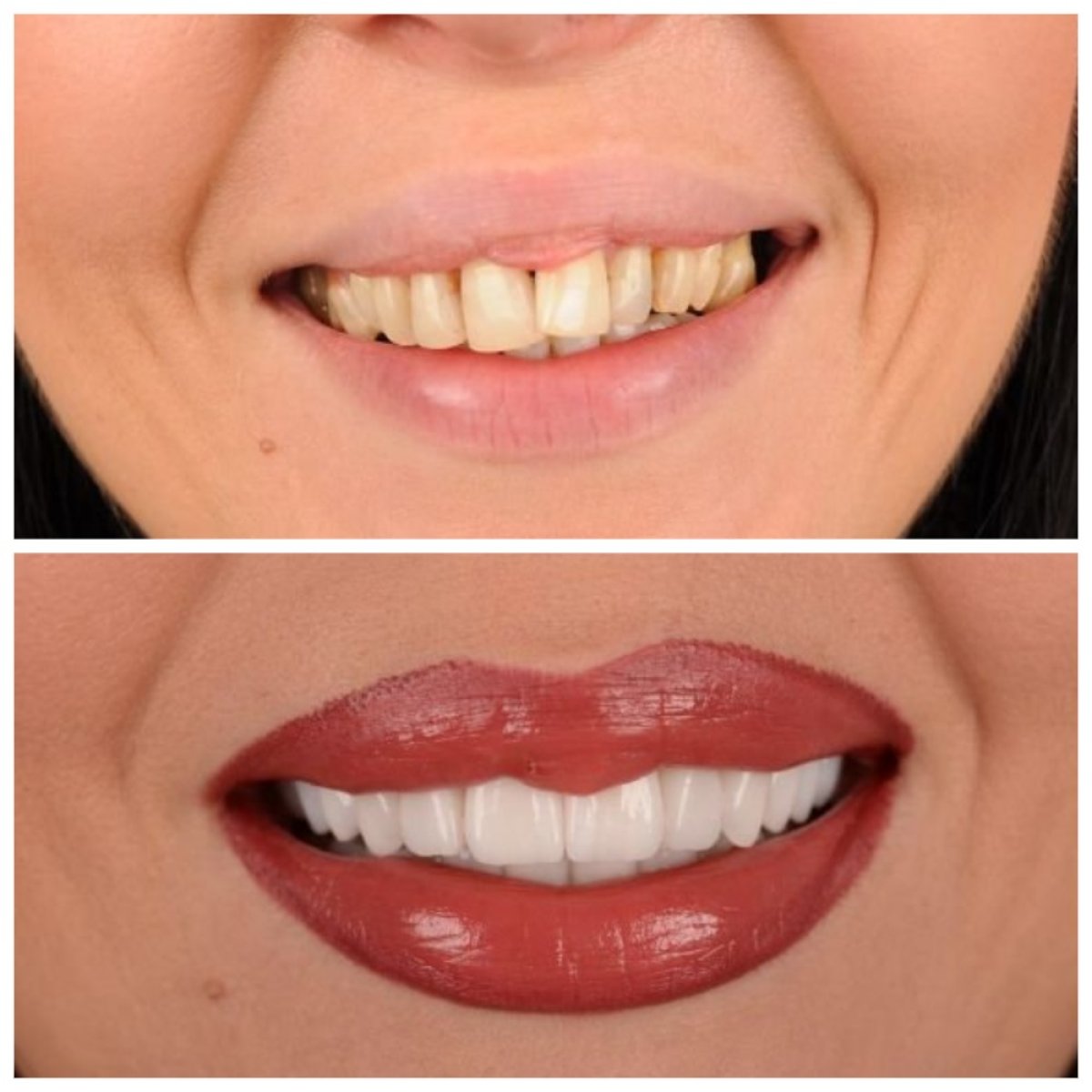 Antes y después de carillas en RIKOTA Dental Clinic: transformación de sonrisa y dientes más blancos