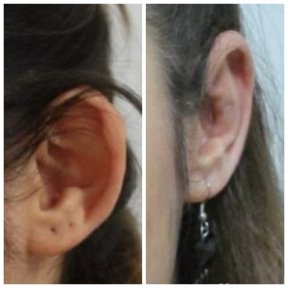 Otoplastik Vorher-Nachher-Ergebnisse bei Assoc.Prof.Dr.Cemal Kara / Medical Park İzmir Hospital