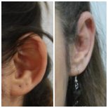 Otoplastik Vorher-Nachher-Ergebnisse bei Assoc.Prof.Dr.Cemal Kara / Medical Park İzmir Hospital
