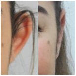 Otoplastik Vorher-Nachher-Ergebnisse bei Assoc.Prof.Dr.Cemal Kara / Medical Park İzmir Hospital
