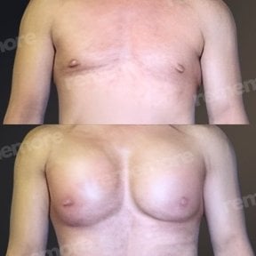 Before and after pectoral implants at Memorial Şişli Hospital, enhanced chest contour result