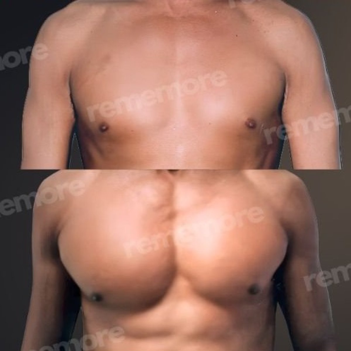 Antes y después de implantes pectorales en Memorial Şişli Hospital, resultados de pecho definido