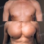 Before and after pectoral implants at Memorial Şişli Hospital, enhanced chest contour results
