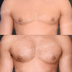 Before and after pectoral implants results at Memorial Şişli Hospital, enhanced chest contour