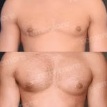 Before and after pectoral implants results at Memorial Şişli Hospital, enhanced chest contour