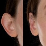 Результаты отопластики до и после в Yurchenko Plastic Surgery Team, коррекция ушей