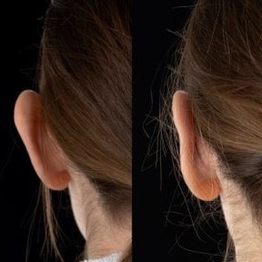 Результаты отопластики до и после в Yurchenko Plastic Surgery Team, коррекция ушей