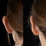 Результаты отопластики до и после в Yurchenko Plastic Surgery Team, коррекция ушей