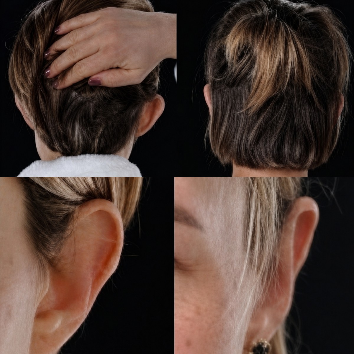 نتائج عملية تجميل الأذن قبل وبعد في Yurchenko Plastic Surgery Team، تصحيح الأذن