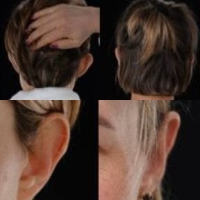 Результаты отопластики до и после в Yurchenko Plastic Surgery Team, коррекция ушей