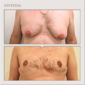 Before and after gynecomastia surgery results at Sienna Clinic, male chest contouring