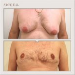 Before and after gynecomastia surgery results at Sienna Clinic, male chest contouring