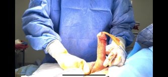 Penile implant surgery procedure at Uroaesthetic clinic – intraoperative stage result