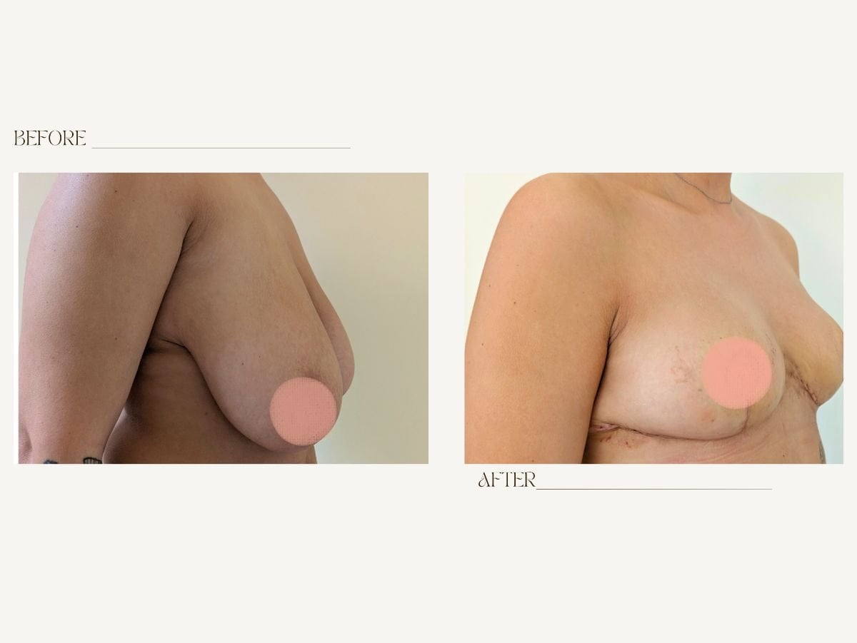 نتائج قبل وبعد تصغير الثدي في InSense Clinic (SV Plastic Surgery Clinic)