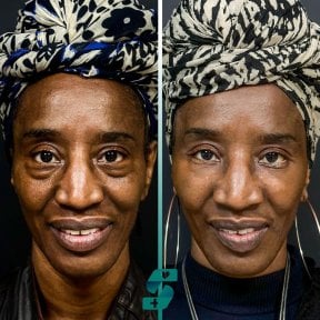 Before and after blepharoplasty results at Soraca Med, eyelid correction for youthful eyes