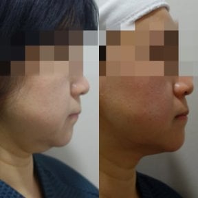 До и после инъекций ботокса в Lalian Cheongdam Clinic, видимый контур подбородка