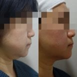 До и после инъекций ботокса в Lalian Cheongdam Clinic, видимый контур подбородка