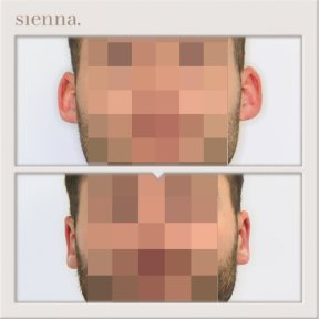 Before and after otoplasty results at Sienna Clinic, improved ear shape and symmetry