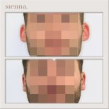 Before and after otoplasty results at Sienna Clinic, improved ear shape and symmetry