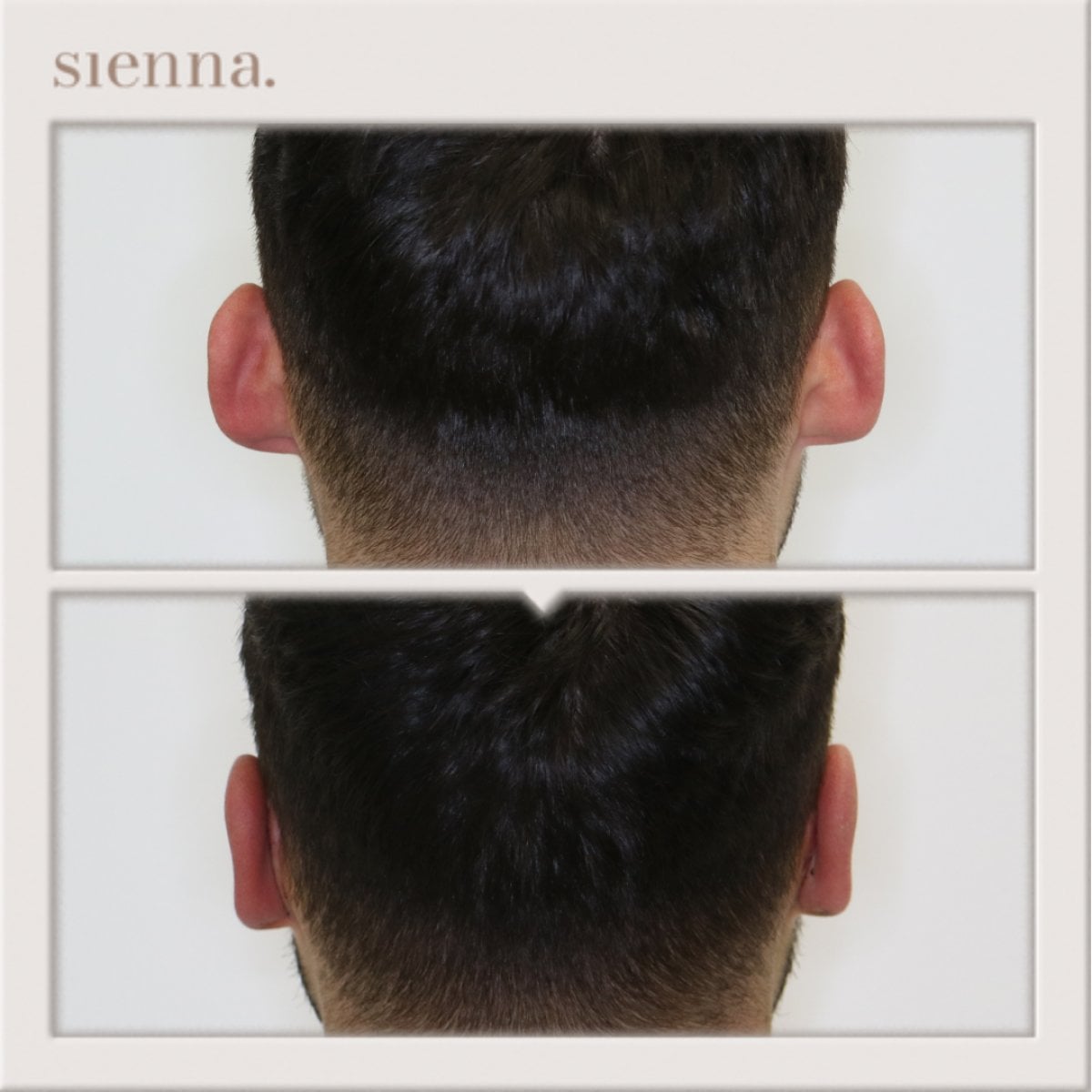 Antes y después de otoplastia en Sienna Clinic – resultado de cirugía de orejas en hombres