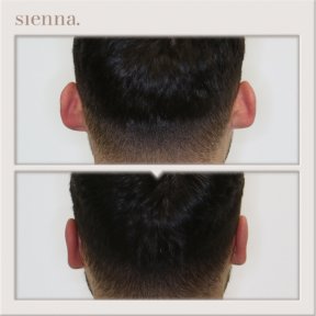 Before and after otoplasty at Sienna Clinic – ear reshaping surgery result for men