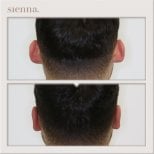 Before and after otoplasty at Sienna Clinic – ear reshaping surgery result for men