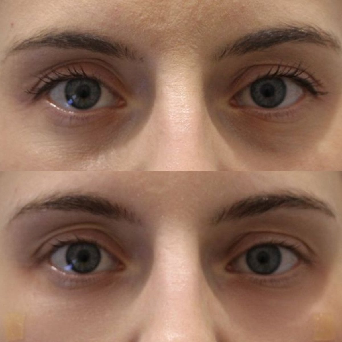 Antes y después de inyecciones de bótox en Forena Clinic, reducción de arrugas en ojos