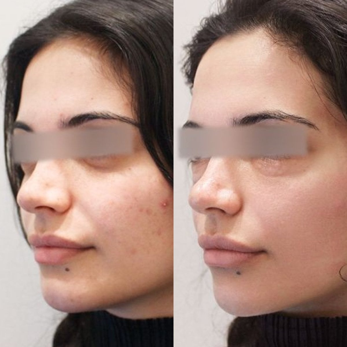 Antes y después de inyecciones de bótox en Forena Clinic, piel más lisa y menos arrugas
