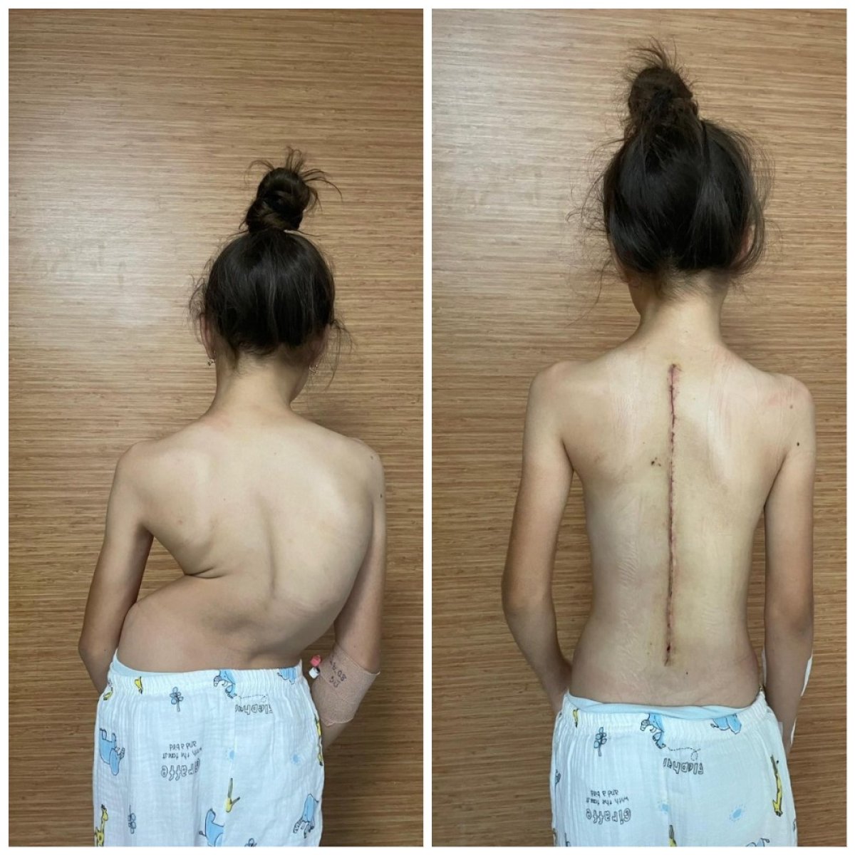 نتيجة قبل وبعد جراحة الجنف في Central Hospital – تقويم العمود الفقري