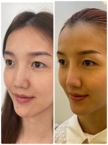 Before and after rhinoplasty results at ID Clinic Bangkok, nose reshaping with natural look