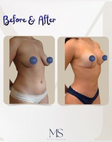نتائج شد الثدي قبل وبعد في عيادة ميشيل سلامة، تحسين شكل الثدي