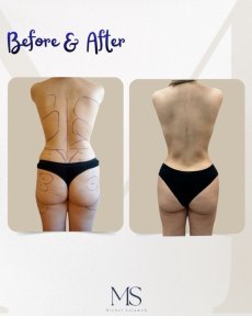 نتائج نحت الجسم قبل وبعد في عيادة ميشيل سلامة – تحسين شكل الجسم