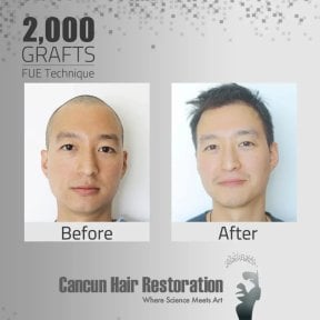 Before and after FUE hair transplant with 2,000 grafts at Cancun Hair Restoration, visible results