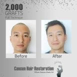 Before and after FUE hair transplant with 2,000 grafts at Cancun Hair Restoration, visible results