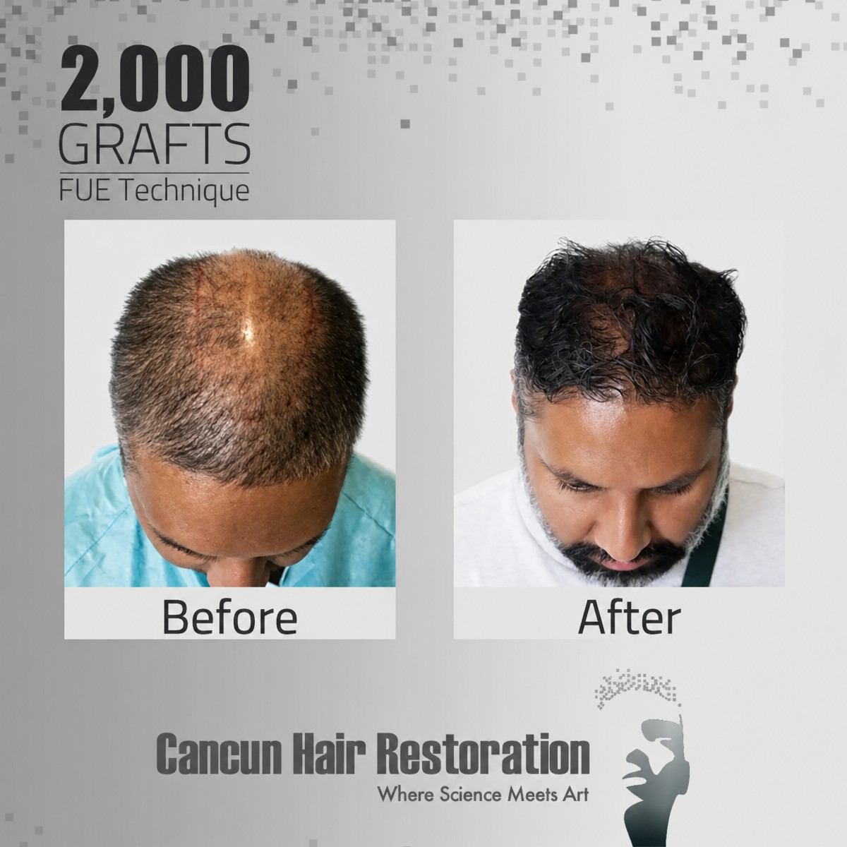 نتائج زراعة الشعر بتقنية FUE مع 3000 طعم في مركز Cancun Hair Restoration قبل وبعد