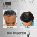 Before and after FUE hair transplant with 3,000 grafts at Cancun Hair Restoration results